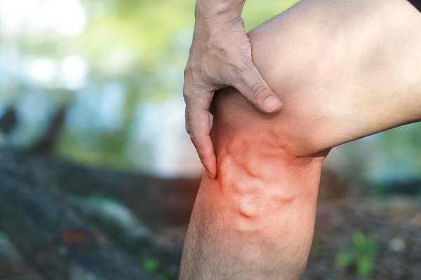 Trápí vás těžké a oteklé nohy? Možná jsou na vině křečové žíly. Víme, co s nimi
