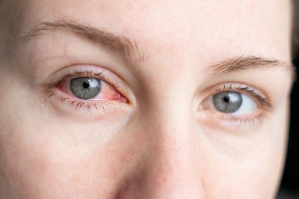 Zarudlé oči a pálení? Může jít o zánět spojivek – víme, jak na něj