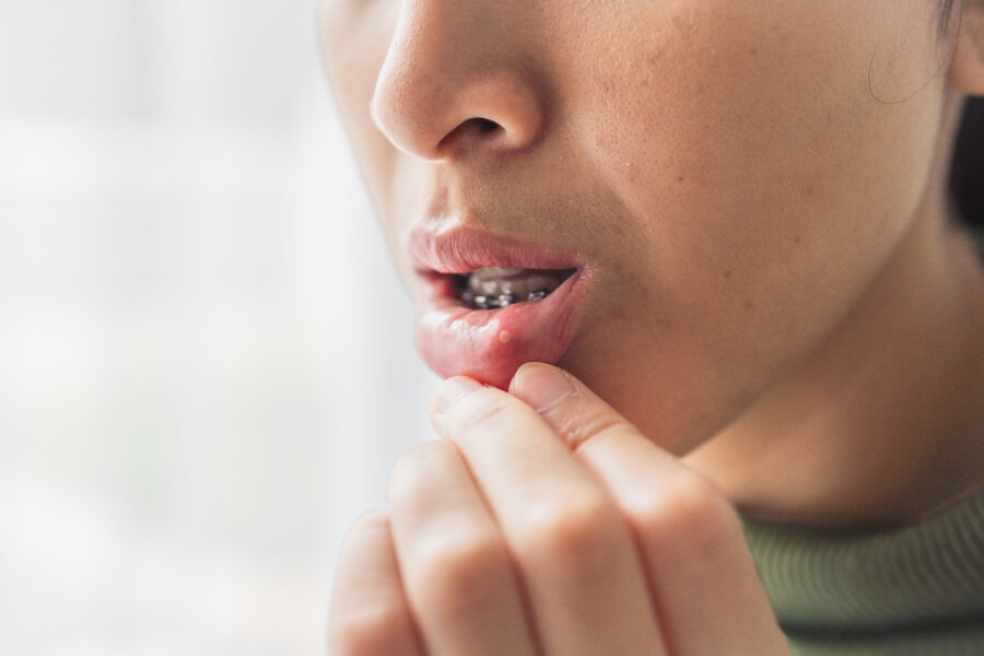 Průběh hojení afty