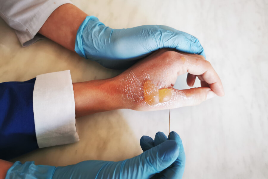 Kdy puchýř rozhodně nepropichovat?