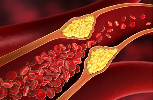 Ucpaná žíla při vysokém cholesterolu